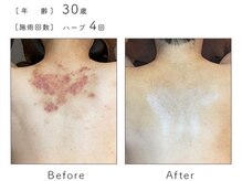 チップ(chip)/30歳／施術4回