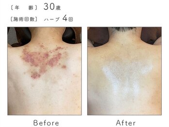 チップ(chip)/30歳/施術4回