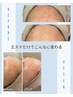 【しみ・しわ】光フェイシャルで紫外線ダメージ予防ふっくら弾力復活