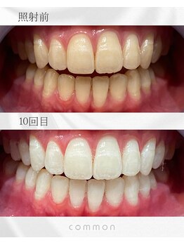 セルフホワイトニングコモン 藤枝店(self whitening common)/10日間ベーシックコース
