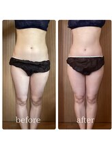 モアナラニ(MoanaLani)/【脂肪冷却】