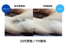 メンズアメリ/高知/メンズ脱毛/ヒゲ/全身/VIO