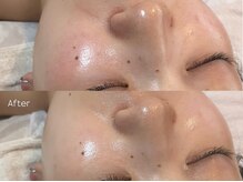 トーン(TONE)/乾燥 / 小ジワ / 赤みの改善ケア