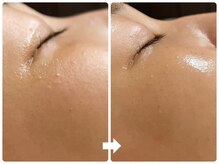 サロン ド ジョワ(salon de joie)/20代毛穴引締めハリ艶肌