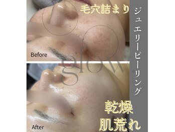グロウ(glow.)/継続ケアでシミ、跡まで綺麗に