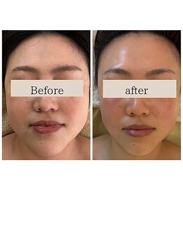 ミピマムマール(Mipimam Maaru)/くすみ・たるみ改善【仙台小顔】