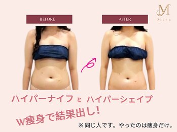 ミラ 札幌店(Mira)/結果が出るW施術