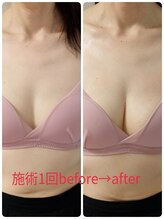 ブルーム 高崎(BLOOM)/1度の施術で 谷間くっきり！！