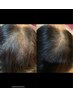 【育毛促進】世界で大注目のヒト幹細胞上清液を使用した最新ヘアケア美容