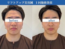 ラ カルナベル(La Carnabel)/美容鍼/耳つぼジュエリー/小顔