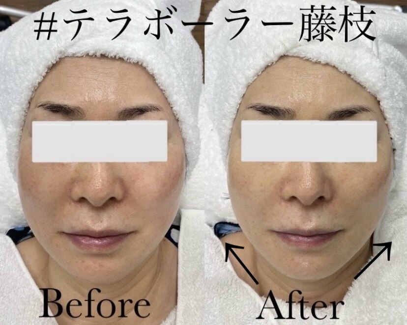 肌質改善エステサロン♡ エステサロン ソワン｜ホットペッパービューティー