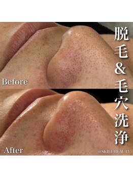 スキル アイラッシュ(SKILL eyelash)/顔脱毛&毛穴洗浄