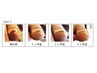 【2回目以降はこちら】巻き爪矯正（3本以上）45分～60分