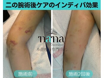 ナナ 銀座(Nana)/二の腕の硬さを緩和できます!