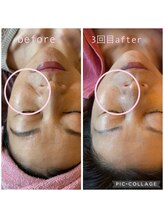 リリアン(Re Lien)/☆ララピールbefore・after☆