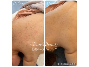 クリーンアンドビューティ 札幌(Clean&Beauty)/どこへ行っても良くならなかった