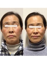 アレイズ/小顔矯正コース（10回）