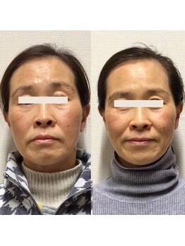 アレイズ/小顔矯正コース(10回)