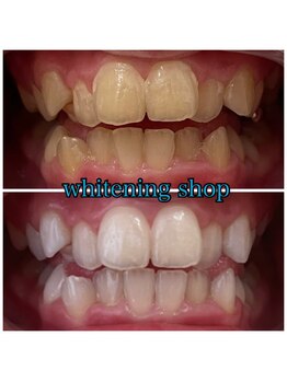 ホワイトニングショップ 明石大久保店/【BeforeAfter】