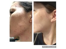 ヨサパーク ルフ 八王子本店(YOSA PARK Rufu)の雰囲気（シルクハーブミストで潤い美肌！ニキビや肌トラブルある方にも◎）