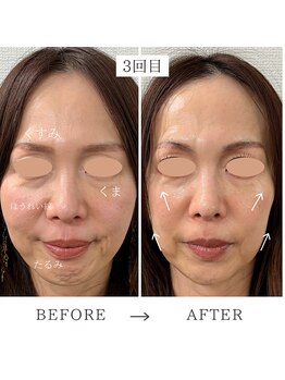 ビューイング(美ing)/糸リフトなしで若見えフェイスへ