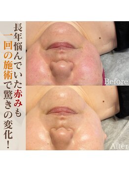 タグ 高知駅前店(Tug)/ハーブピーリング