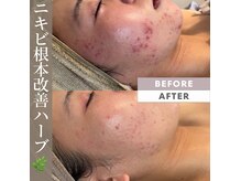 ビューティリュクス(beauty luxe)の雰囲気（諦めていたお肌悩みに！超肌質改善ハーブピーリングが◎）