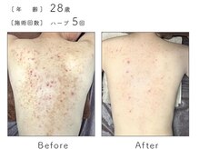 チップ(chip)/28歳／施術5回