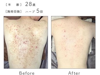 チップ(chip)/28歳/施術5回