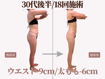 ベモーレ 谷町九丁目 上本町/30代後半/18回施術