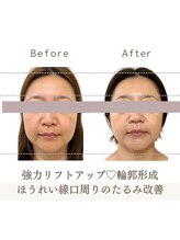 リスサロンドナース(LYS salon de Nurse)/【脂肪燃焼】小顔たるみケア