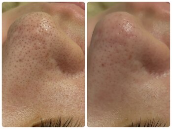 クラージュ/毛穴洗浄3Dで黒ずみ撃退！！