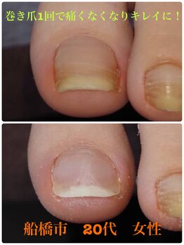 巻き爪じゅん 千葉駅前店/巻き爪1回で変わった！