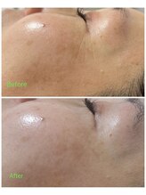 サンライズ ワックス(Sunrise Wax)/圧倒的美白！お顔の脱毛/顔脱毛