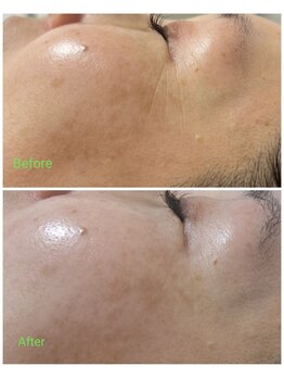 サンライズ ワックス(Sunrise Wax)/圧倒的美白!お顔の脱毛/顔脱毛