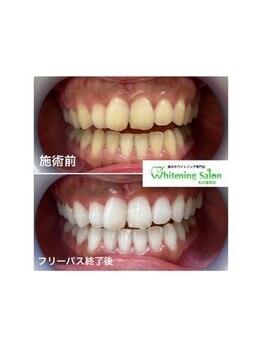 ホワイトニングサロン 名古屋駅店/【ホワイトニング施術例】