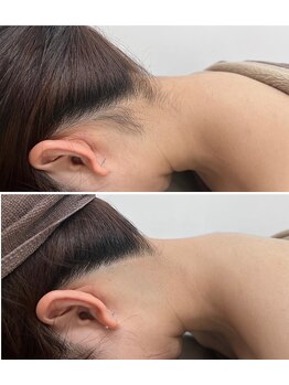 ミース 江坂店/うなじ●ビフォーアフター