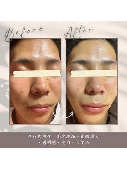 エクラ アン(eclat.un)/毛穴洗浄＋炭酸導入：20代男性