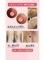 プライベートエステサロン トゥインクル&nbsp;メラニンケアで、全身の気になる黒ずみをピンクorトーンアップ！