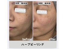 ルアナ 北谷店/ハーブピーリング 《沖縄/北谷》