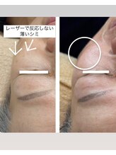 リバイセリー(Revicelly)/比較写真