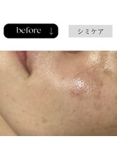 アイチューズ(ICHOOSE)/くすみの対策はホワイトピール