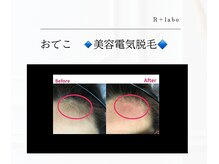 アールプラスラボ(R+labo)/美容電気脱毛のこれがすごい！