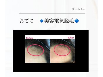 アールプラスラボ(R+labo)/美容電気脱毛のこれがすごい！