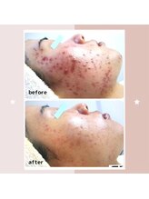 レゾン 京橋店/【ビフォーアフター】ニキビケア