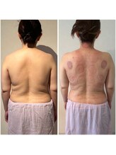 ビレイ(Birei)/カッサ＋カッピング