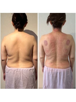 ビレイ(Birei)/カッサ＋カッピング