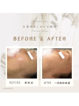 セメヴェール(Saimervell)/昔からの悩みもしみケアで改善！