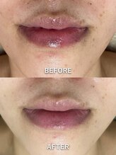 サロンドジェシカ(salon de Jessica)/プラズマ　口周りの改善