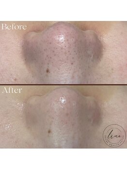 リノ(Lino)/BeforeAfter